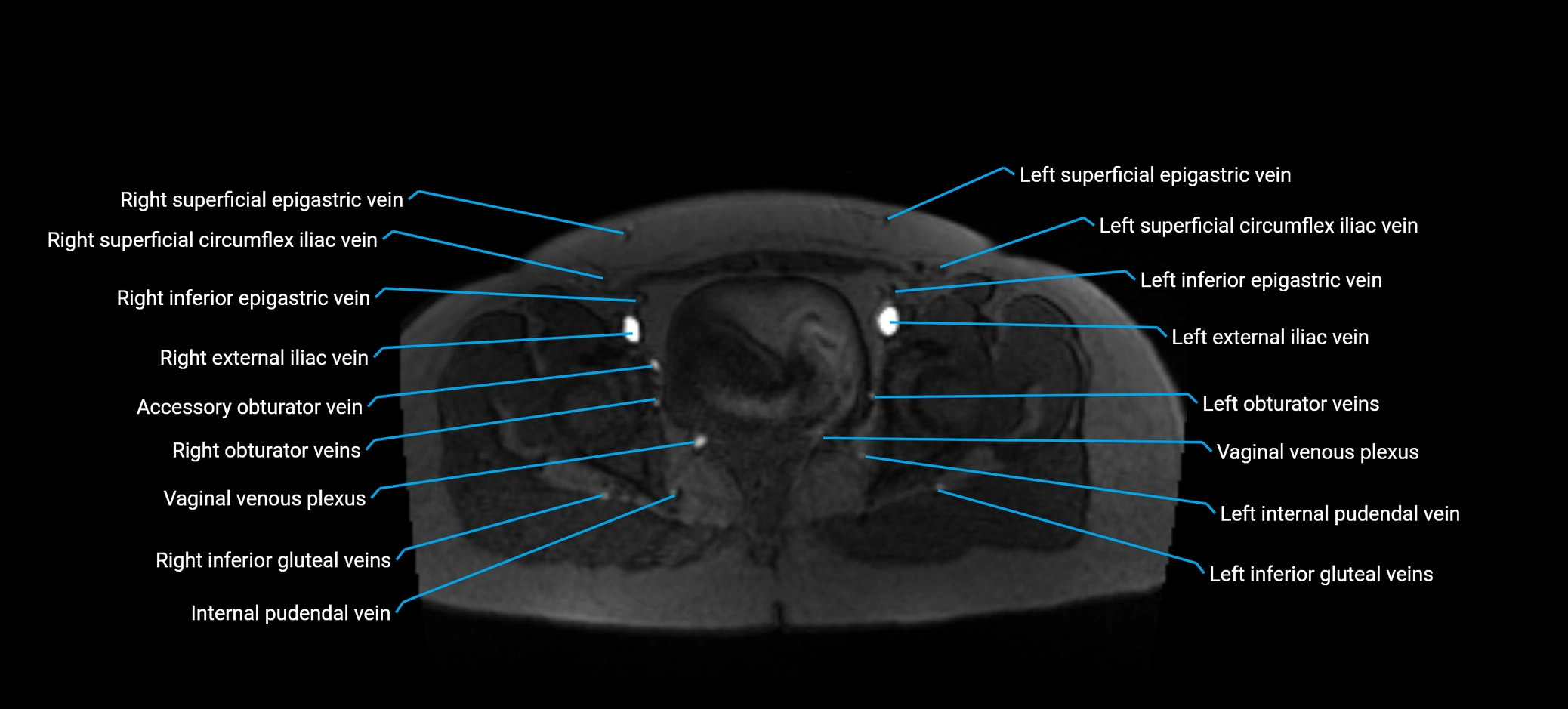 MRV abdomen pelvis & lower limb axial cross sectional anatomy labelled MRI image 177 (1).webp